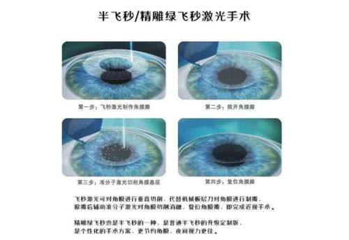 白内障手术套餐