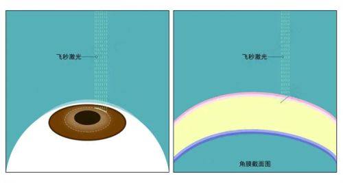 全飞秒手术