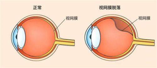 二、 广州半飞秒激光医院哪家好——私立眼科医院技术优势与推荐