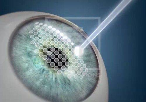 广州爱尔眼科医院2025价格表怎么样？近视手术9800元起，价格透明！