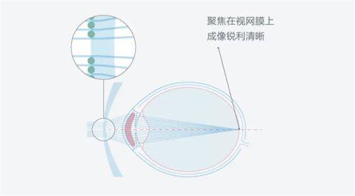 二、西安医大眼科医院青光眼费用优势明显