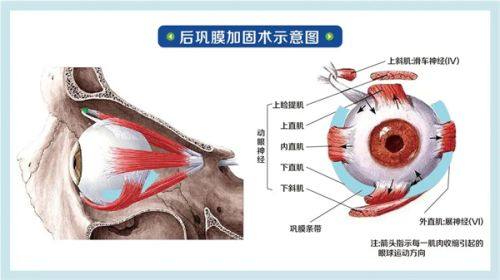 二、深圳佰视佳眼科医院收费不贵，优势在哪？