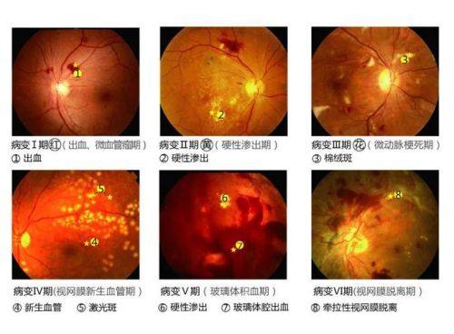 二、北京民众眼科医院视网膜血管病变费用背后的优势