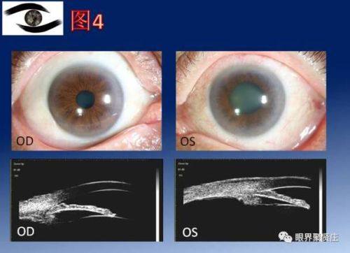 郑州爱尔眼科医院青光眼技术成熟吗？成熟！专业团队和先进设备，为青光眼治疗保驾护航！ 