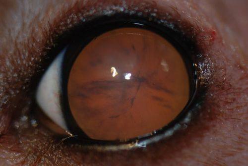 西安奕鸣眼科医院高玮白内障能相信吗？能！经验丰富技术靠谱，患者术后反馈超棒呢！ 