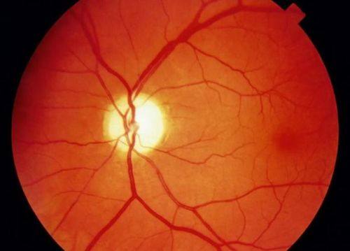 二、杭州飞秒秒眼科医院视神经萎缩2026年优惠活动的优势特色