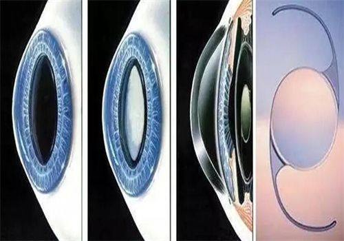 二、越秀区眼科医院收费高不高怎么样？