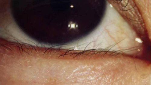 二、北京熙仁眼科医院王乐今倒睫治疗的成效及优势