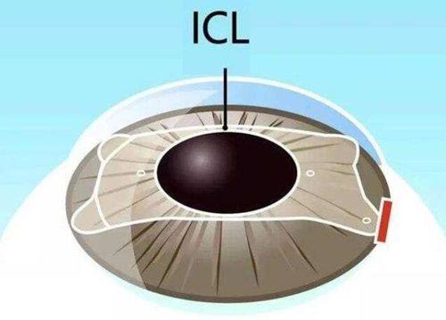 ICL晶体植入套餐