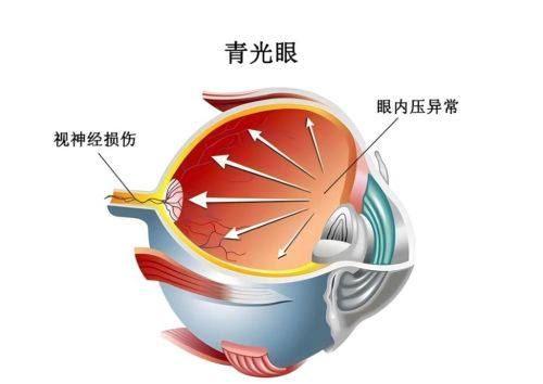 二、昆明普瑞眼科青光眼费用背后的优势