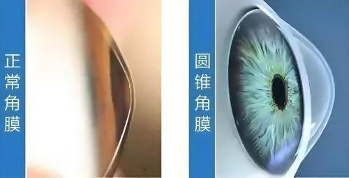 圆锥角膜套餐