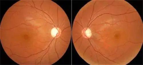 视神经萎缩套餐