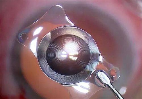 二、济源尖峰眼科医院收费标准怎么样？