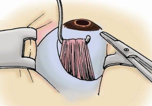 湛江爱尔眼科医院收费标准：近视手术12000/白内障8000元起！