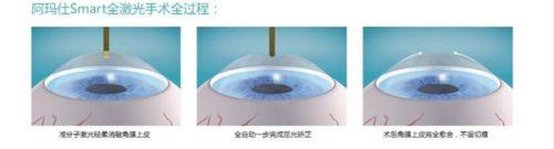 广州视献眼科门诊部李娇娇收费贵吗？不贵，5000元起，性价比高！ 