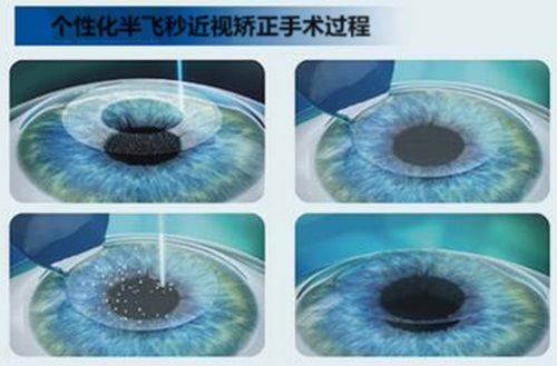 二、连云港爱尔眼科医院收费标准背后的优势