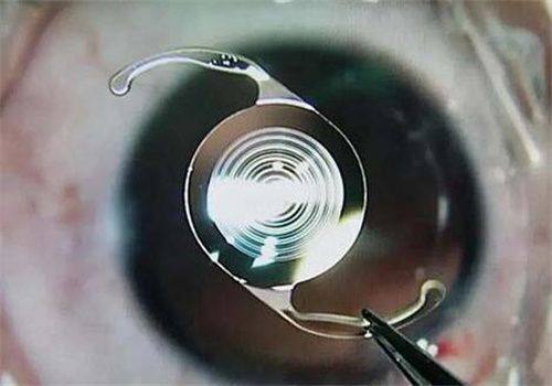 武汉协和医院眼科收费标准揭秘：半飞秒18800元起，全飞秒22800元起