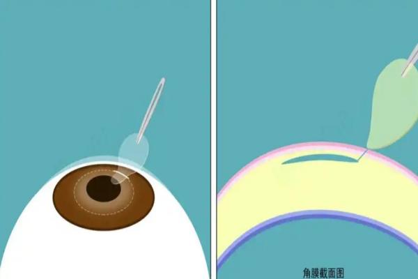近视手术套餐