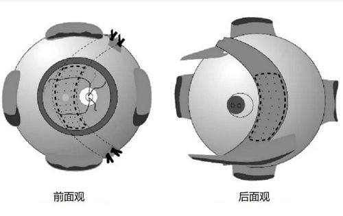 2026爱尔眼科飞秒激光手术：技术优势让价格更具价值
