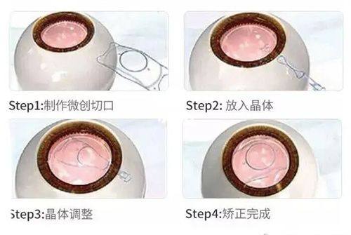 二、长治爱尔眼科医院预约挂号流程是怎样的？