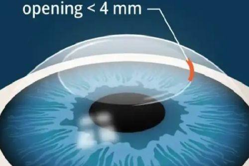 三、北京爱尔新力眼科诊所营业时间的患者便利之处