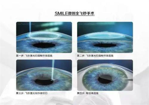 二、北京华德眼科医院近视手术预约挂号：