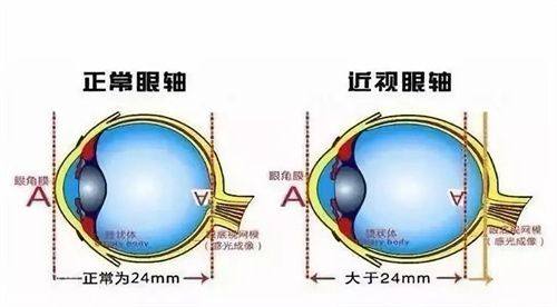 三、 关于近视手术价格与真实实例参考
