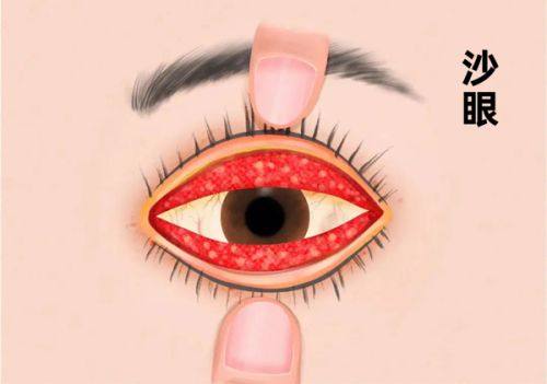 三、 西安四院马波眼科医生为什么值得找？这3个真实实例告诉你答案！www.web508.com