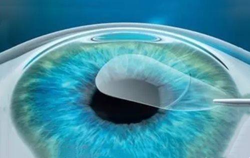 慈溪博视眼科医院好不好？三级专科医保定点，院长帮失明20年阿姨复明！