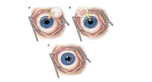 沈晔医生做近视手术怎么样？ICL界29年老司机给你稳稳的摘镜安全感！