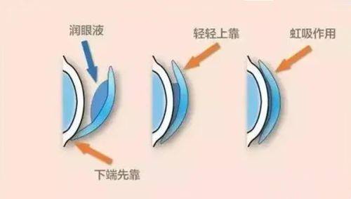 三、选择维视眼科做白内障的额外考量www.web508.com