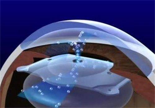 二、 在徐州做近视手术，为什么那么多人选它？www.web508.com