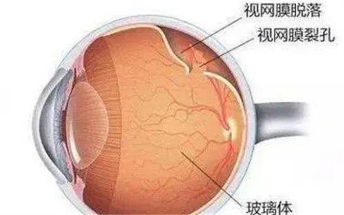 近视手术套餐