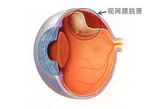 近视手术套餐