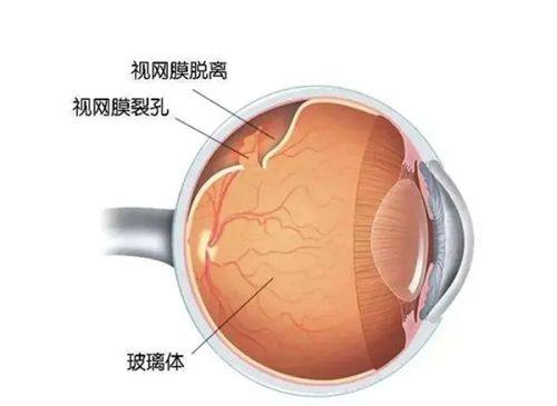 近视手术套餐