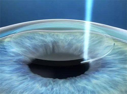 四、成都佰视佳眼科医院的价格、口碑评价和实例分享www.web508.com