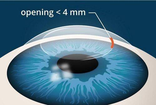 新疆空军眼科医院收费标准揭秘：全飞秒12000元起
