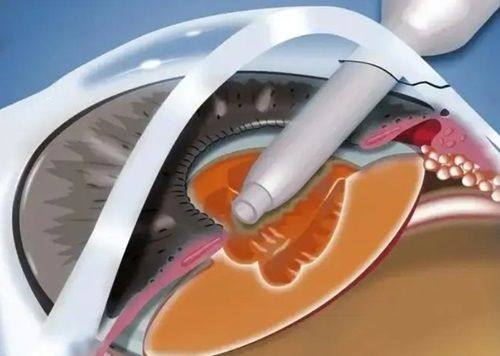 聊城光明眼科医院是公立的吗？不是！它实力咋样？技术好口碑佳在哪呢？ 