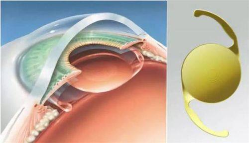 西安奕鸣眼科医院是公立的吗？不是！它口碑咋样？实力强技术好！ 