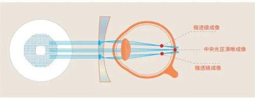 二、毕节阳明眼科屈光手术价格www.web508.com