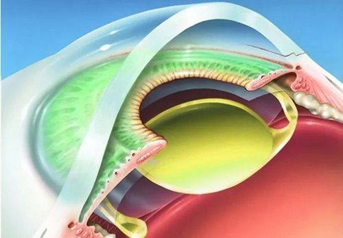 二、泉州做全飞秒手术哪家好www.web508.com
