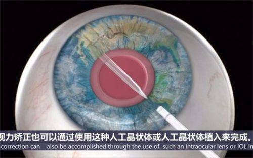 二、爱尔眼科就诊时间安排www.web508.com