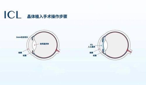 郑州尖峰眼科医院刘保松ICL晶体植入手术常见疑问解答www.web508.com