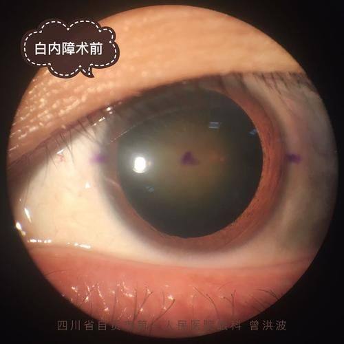 郑州尖峰眼科医院刘保松白内障手术的常见疑问解答www.web508.com