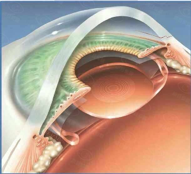 白内障飞秒激光好还是人工晶体好www.web508.com