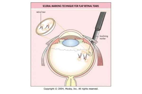 后巩膜加固术后多久可正常用眼web508.com