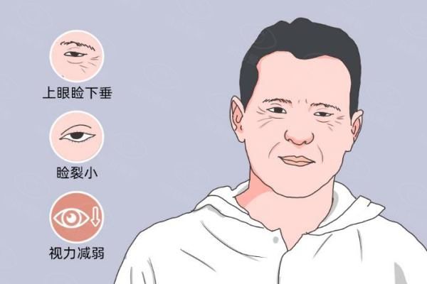 上眼睑下垂怎么治疗？可通过药物|手术等进行治疗，另附改善方法+年龄条件！web508.com