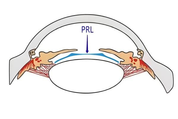 PRL晶体植入与ICL的哪个更好web508.com