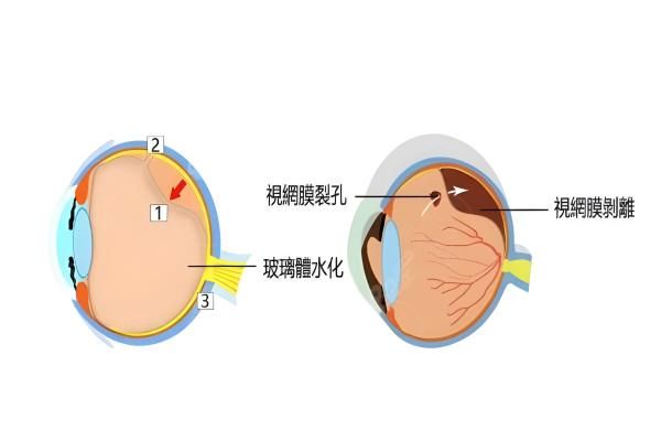 1000度必须做后巩膜加固手术吗web508.com