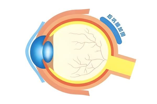 1000度必须做后巩膜加固手术吗web508.com
